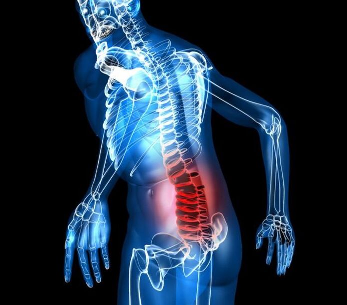Juosmens osteochondrozės laipsnio ir vystymosi stadijos