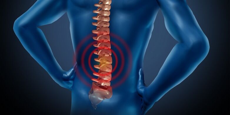 Juosmens srities osteochondrozė