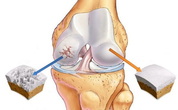 Kelio sąnario (kairėje) ir normalios kremzlės (dešinėje) osteoartritas