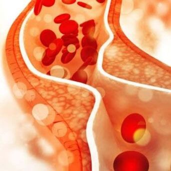Cholesterolio nusėdimas ant vidinių kraujagyslių sienelių sukelia skausmą kaklo šone