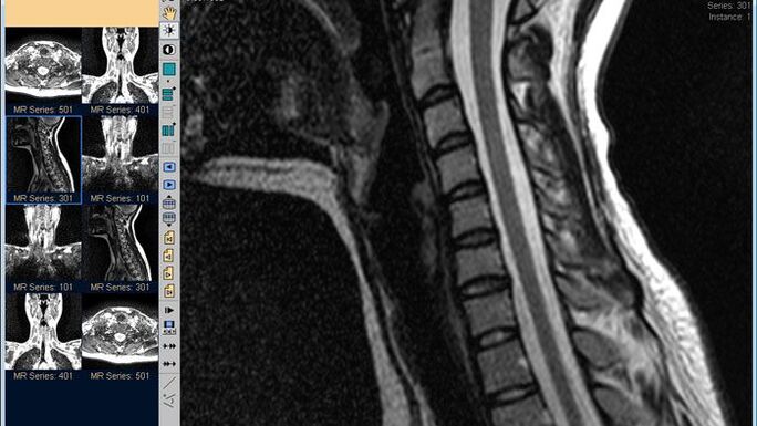 Gimdos kaklelio stuburo MRT yra geriausias būdas diagnozuoti kaklo skausmą
